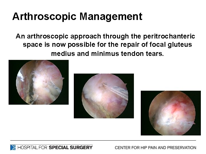 Arthroscopic Management An arthroscopic approach through the peritrochanteric space is now possible for the