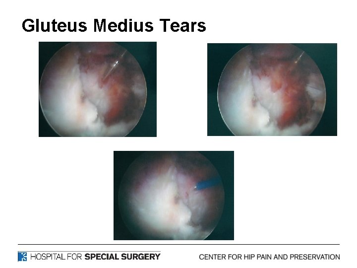 Gluteus Medius Tears 