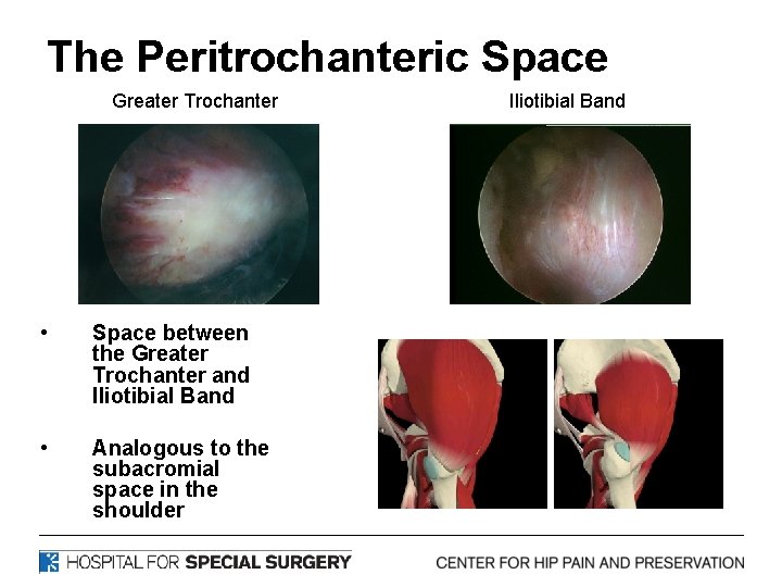 The Peritrochanteric Space Greater Trochanter • Space between the Greater Trochanter and Iliotibial Band