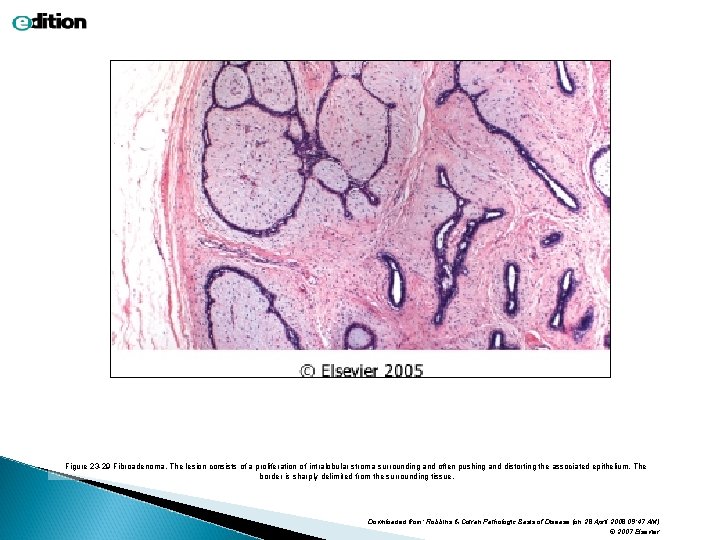 Figure 23 -29 Fibroadenoma. The lesion consists of a proliferation of intralobular stroma surrounding