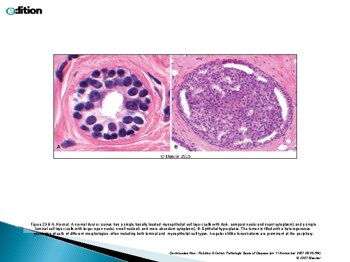 Figure 23 -8 A, Normal. A normal duct or acinus has a single basally