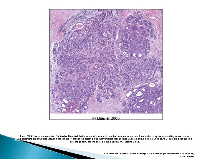 Figure 23 -9 Sclerosing adenosis. The involved terminal duct lobular unit is enlarged, and