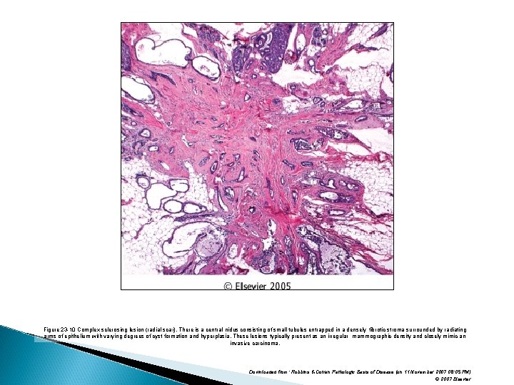 Figure 23 -10 Complex sclerosing lesion (radial scar). There is a central nidus consisting