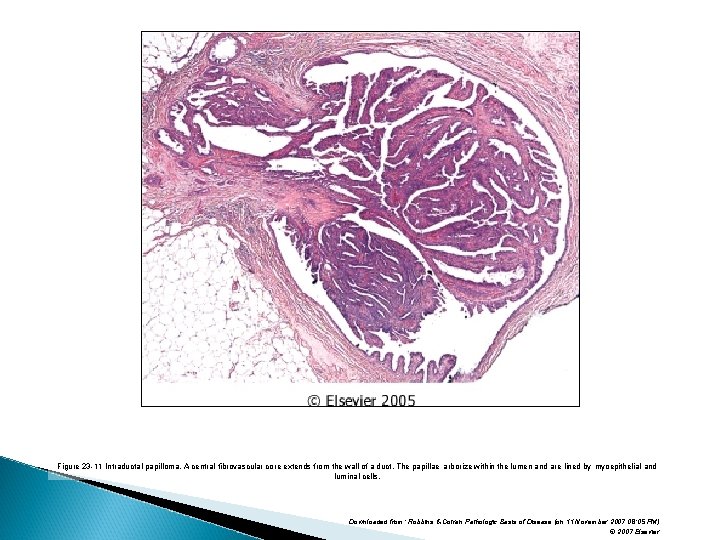 Figure 23 -11 Intraductal papilloma. A central fibrovascular core extends from the wall of