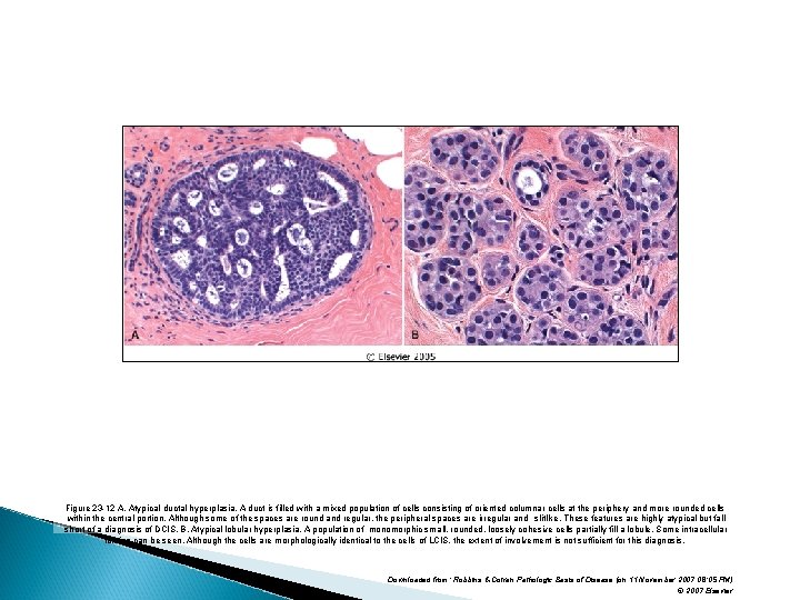 Figure 23 -12 A, Atypical ductal hyperplasia. A duct is filled with a mixed