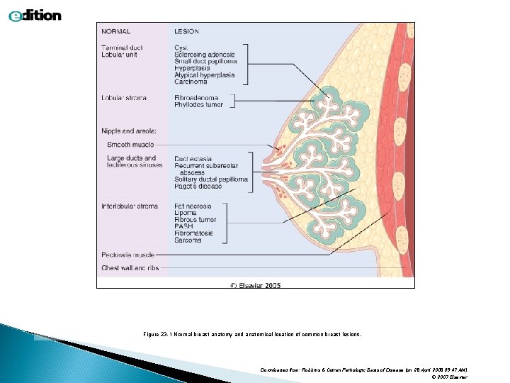 Figure 23 -1 Normal breast anatomy and anatomical location of common breast lesions. Downloaded