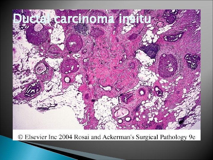 Ductal carcinoma insitu 