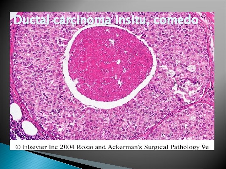 Ductal carcinoma insitu, comedo 