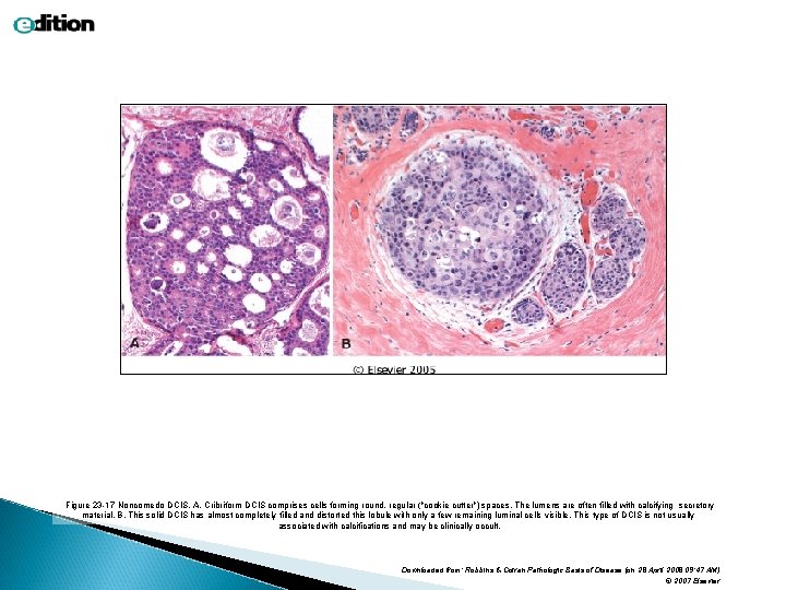 Figure 23 -17 Noncomedo DCIS. A, Cribriform DCIS comprises cells forming round, regular ("cookie