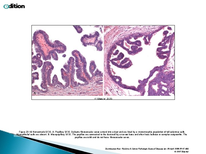 Figure 23 -18 Noncomedo DCIS. A, Papillary DCIS. Delicate fibrovascular cores extend into a