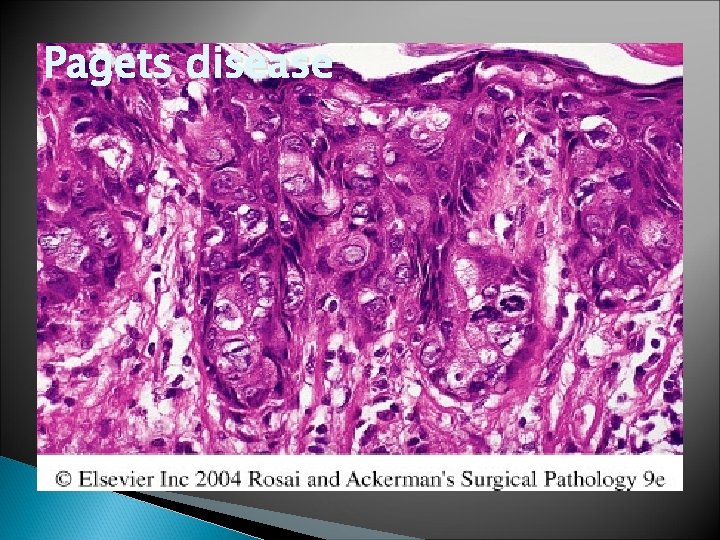 Pagets disease 