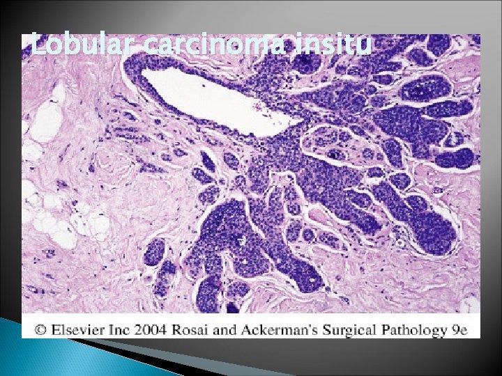 Lobular carcinoma insitu 