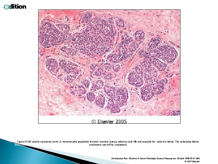 Figure 23 -20 Lobular carcinoma in situ. A monomorphic population of small, rounded, loosely