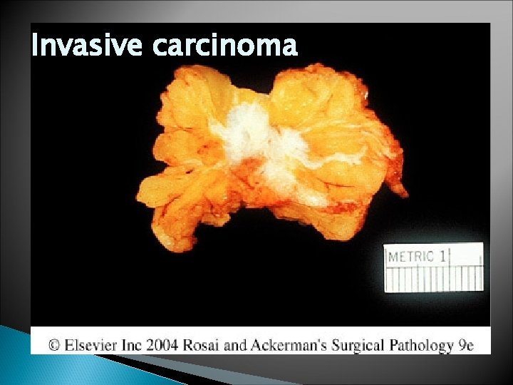 Invasive carcinoma 