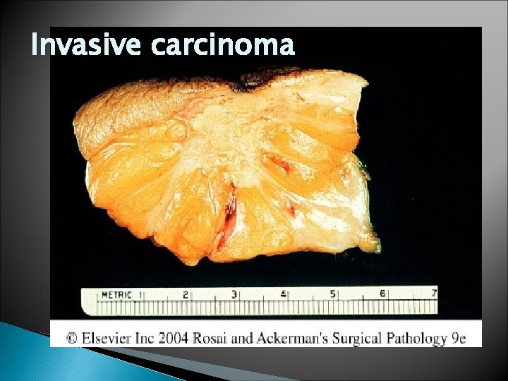 Invasive carcinoma 