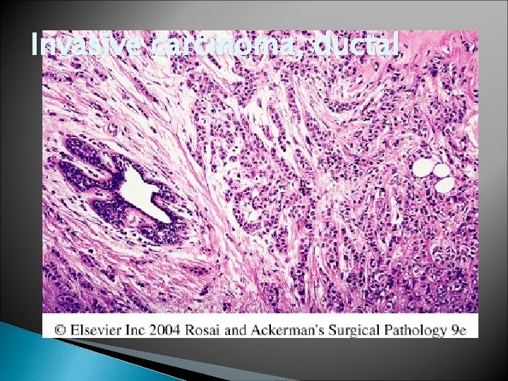 Invasive carcinoma, ductal 