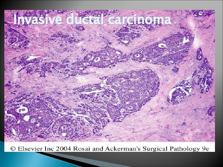 Invasive ductal carcinoma 