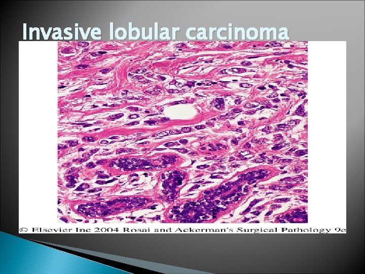 Invasive lobular carcinoma 