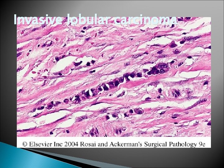 Invasive lobular carcinoma 