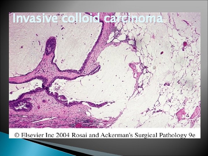 Invasive colloid carcinoma 