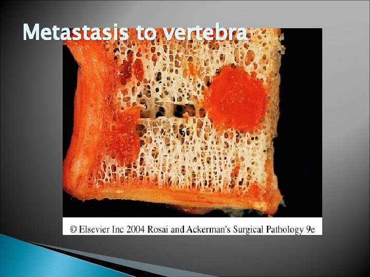 Metastasis to vertebra 