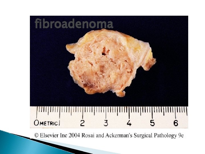 fibroadenoma 