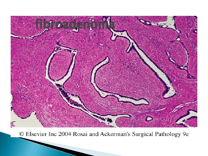 fibroadenoma 