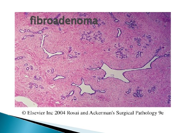 fibroadenoma 