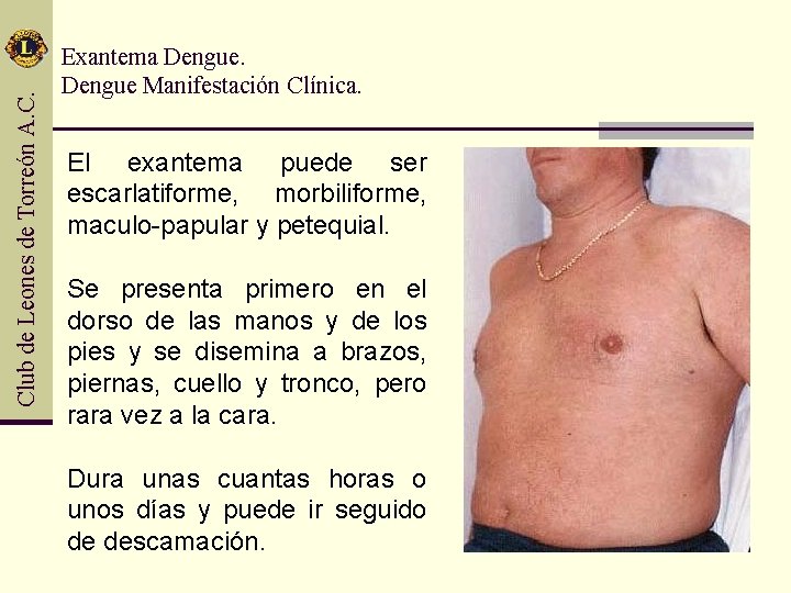 Club de Leones de Torreón A. C. Exantema Dengue Manifestación Clínica. El exantema puede