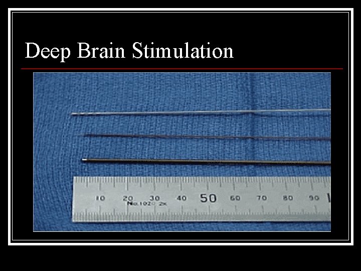Deep Brain Stimulation 