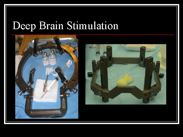 Deep Brain Stimulation 