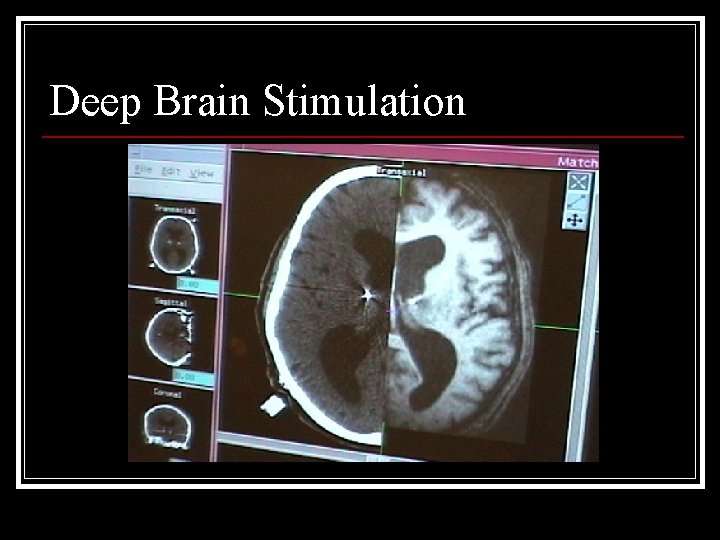 Deep Brain Stimulation 