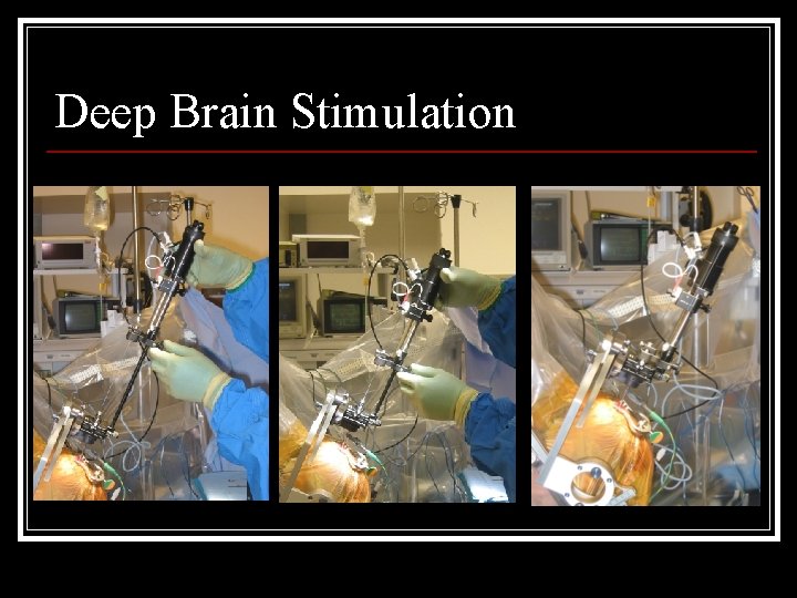 Deep Brain Stimulation 