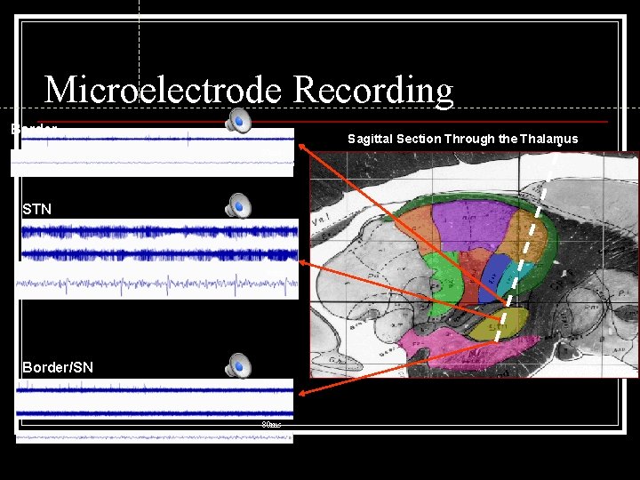 Microelectrode Recording Border 10 sec 80 ms STN 10 sec 80 ms Border/SN 10