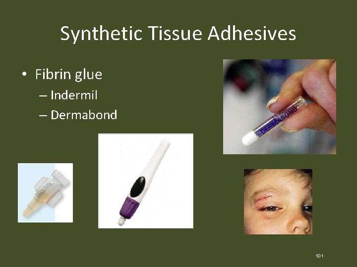 Synthetic Tissue Adhesives • Fibrin glue – Indermil – Dermabond 101 