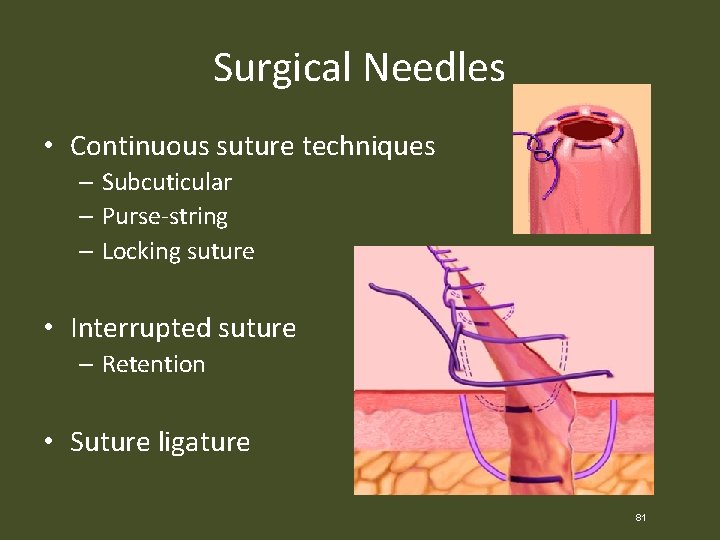 Surgical Needles • Continuous suture techniques – Subcuticular – Purse-string – Locking suture •