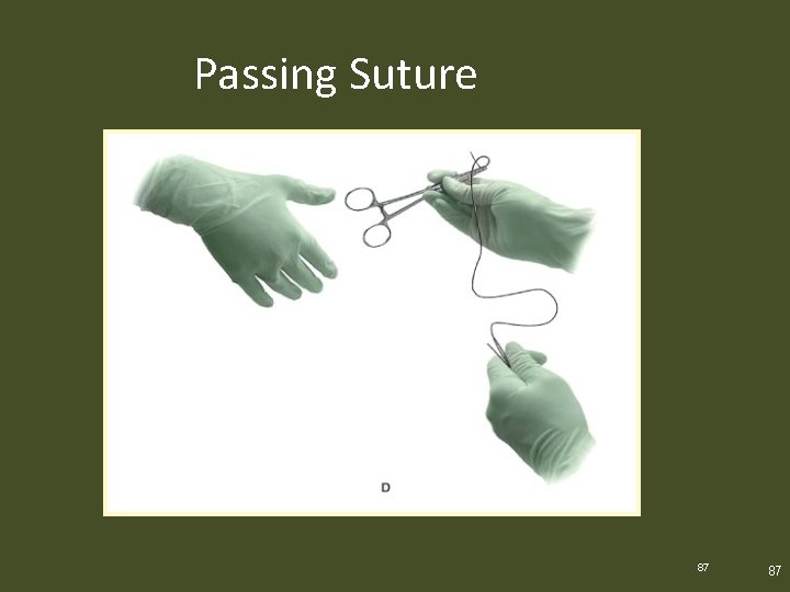 Passing Suture 87 87 