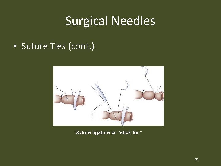 Surgical Needles • Suture Ties (cont. ) Suture ligature or "stick tie. " 91