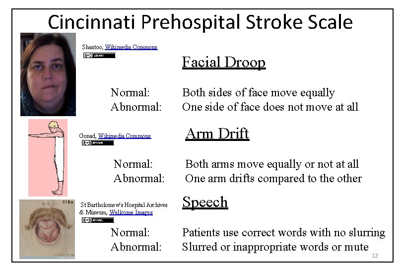 Cincinnati Prehospital Stroke Scale Shantoo, Wikimedia Commons Facial Droop Normal: Abnormal: Gonad, Wikimedia Commons