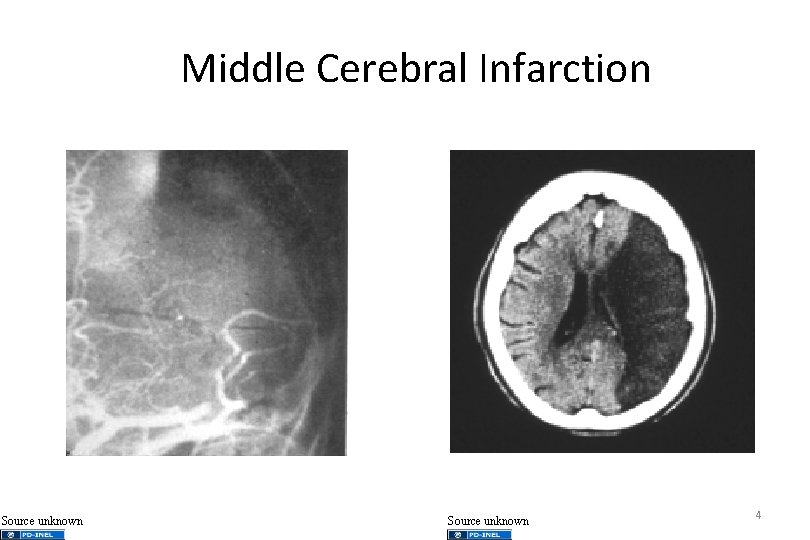 Middle Cerebral Infarction Source unknown 4 