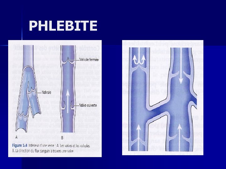 PHLEBITE 