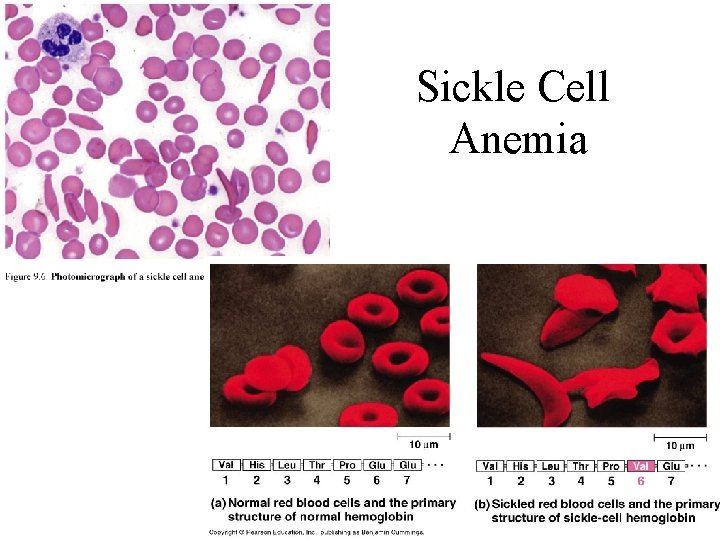 Sickle Cell Anemia 