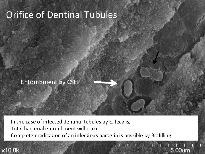 Orifice of Dentinal Tubules Entombment by CSH In the case of infected dentinal tubules