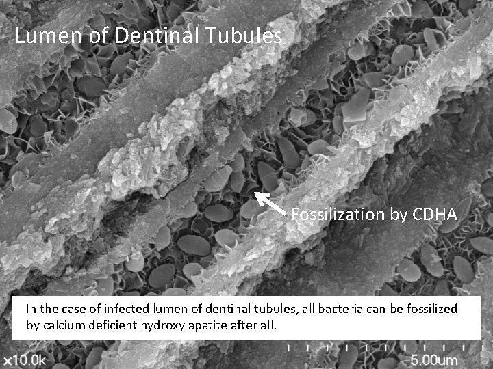 Lumen of Dentinal Tubules Fossilization by CDHA In the case of infected lumen of Lumen of Dentinal Tubules Fossilization by CDHA In the case of infected lumen of