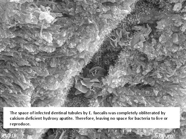 The space of infected dentinal tubules by E. faecalis was completely obliterated by calcium The space of infected dentinal tubules by E. faecalis was completely obliterated by calcium