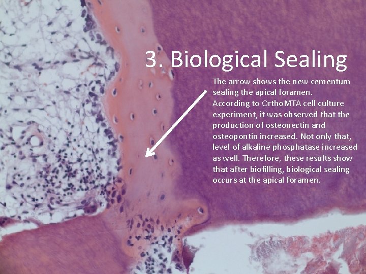 3. Biological Sealing The arrow shows the new cementum sealing the apical foramen. According