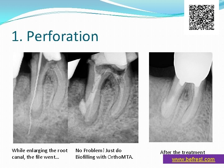 1. Perforation While enlarging the root canal, the file went… No Problem! Just do 1. Perforation While enlarging the root canal, the file went… No Problem! Just do