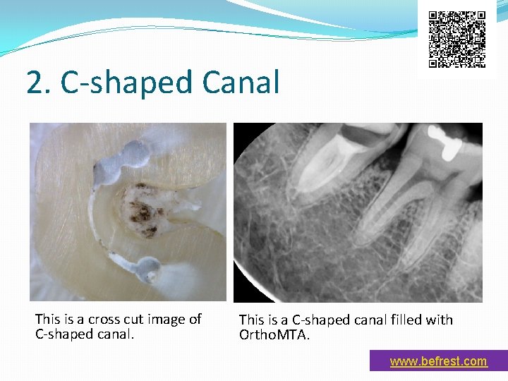 2. C-shaped Canal This is a cross cut image of C-shaped canal. This is 2. C-shaped Canal This is a cross cut image of C-shaped canal. This is