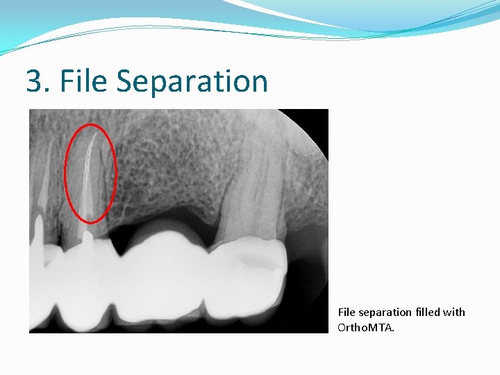 3. File Separation File separation filled with Ortho. MTA. 3. File Separation File separation filled with Ortho. MTA.