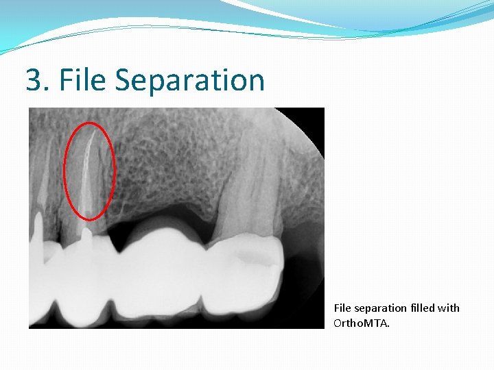 3. File Separation File separation filled with Ortho. MTA. 